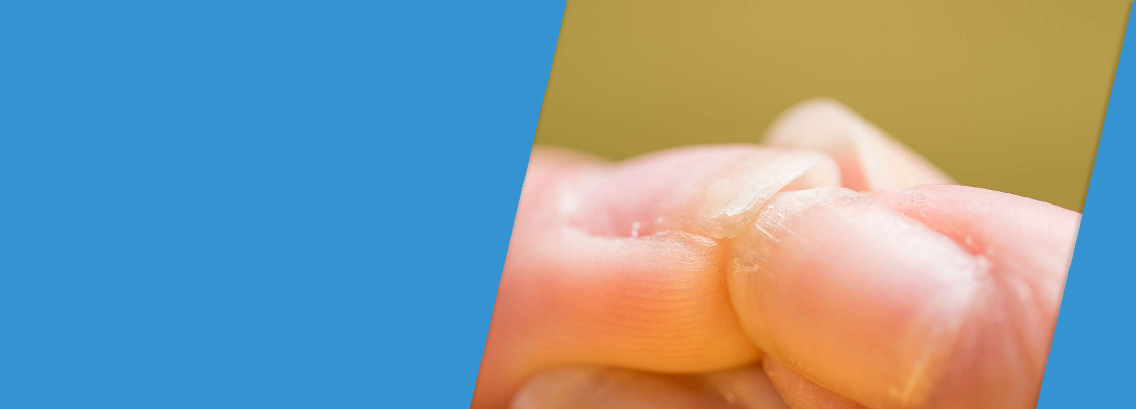 Brüchige Nägel? Zinkmangel kann eine Rolle spielen. Apothekensuche.de